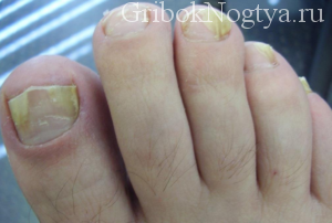 Ознаки грибка на нігтях ніг