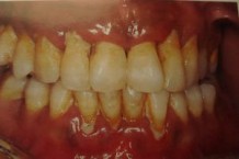 Igiena orală individuală profesională în medicina dentară