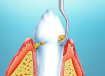 Igiena orală individuală profesională în medicina dentară