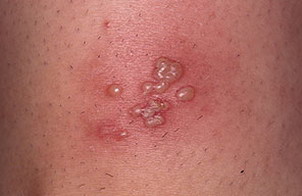 Herpes simplex