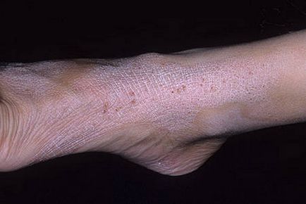 Diagnosticul lichen cronic simplu, cauze, tratament