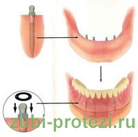 Protetica stomatologică cu proteze pe încuietori și implanturi globulare