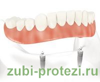 Протезування зубів за допомогою протезів на кулястих замках і імплантатах