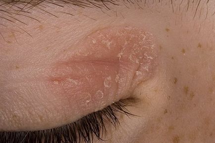 Psoriasis előtt egy fotót az érintett korú, tünetek, kezelés összetettsége