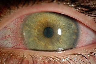 Psoriasis a szem és a szemhéjak szemmel