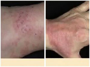 Плями на шкірі після дерматиту, лікування дерматиту