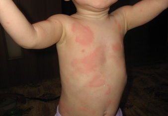 Плями при алергії у дітей фото