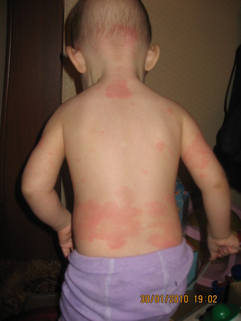 Плями при алергії у дітей фото