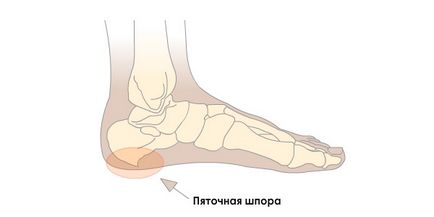 Călcâi provoca, tratament cu remedii folclorice, prevenire