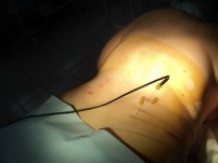 Rádiófrekvenciás abláció (RFA) (rádiófrekvenciás kezelés osteoarthritis a gerinc) Rádiófrekvenciás ablációs (RFA)