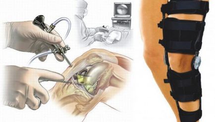 Strângerea articulațiilor genunchiului, simptome, tratament, recuperare