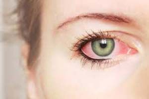 Роздратування навколо очей, як зняти подразнення шкіри навколо очей