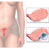 Ruptura chistului ovarian - bisturiu - informație medicală și portal educațional