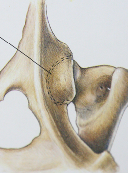 Ruptura ligamentelor