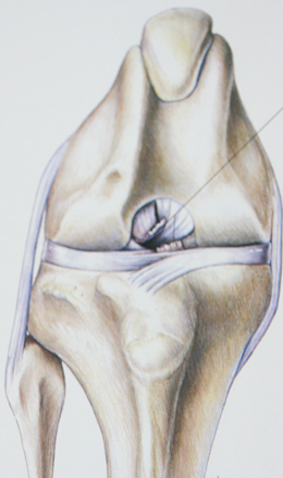 Ruptura ligamentelor