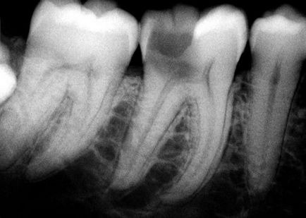 Diagnosticarea razei X a stării dinților