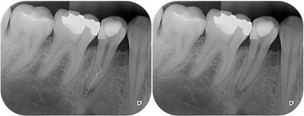 Рентген-діагностика стану зубів