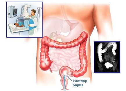 X-ray a rectului cu contrastantă sau irrigoscopie