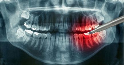 Рентген зуба що це, як проводитися і як часто можна робити рентген зубів