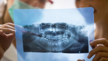 Рентген зуба що це, як проводитися і як часто можна робити рентген зубів