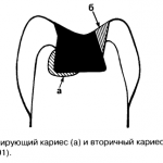 visszatérő fogszuvasodás