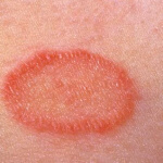 Roz lichen într-o fotografie persoană, simptome și tratament