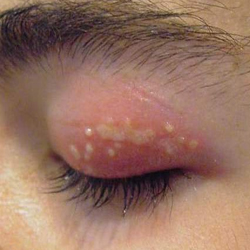 Симптоми і лікування герпесу на очах