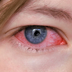 Симптоми і лікування герпесу на очах