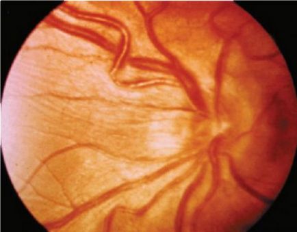 Spasmul vaselor simptomelor oculare și tratamentul cu metode moderne, uflebologa