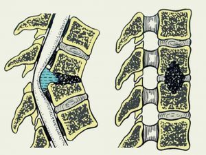 spondylitis a gerinc - a jelek, tünetek és a betegség kezelésében