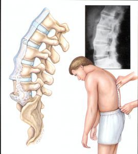 spondylitis a gerinc - a jelek, tünetek és a betegség kezelésében