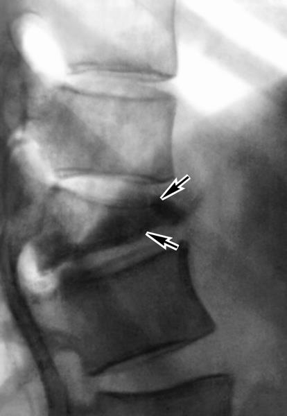 spondylitis a gerinc - a jelek, tünetek és a betegség kezelésében