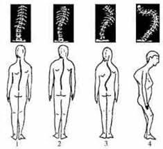 ступеня сколіозу