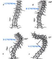 A fok scoliosis (mindegyik súlyosbítani fogják) mértékétől scoliosis