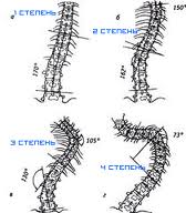ступеня сколіозу