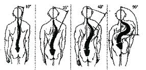 ступеня сколіозу