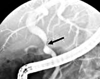 Stricturi ale conductelor biliare - cauze, simptome, diagnostic și tratament