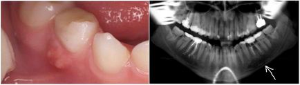 Fistula pe gingia dinte provoacă, simptome și tratament