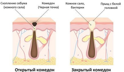 Veți recunoaște acest lucru din mii de 18 componente ale produselor cosmetice comedogene