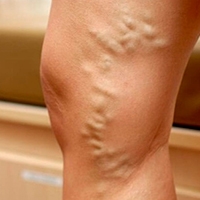 Трофічні зміни шкіри при варикозі лікування виразки на ногах народними засобами