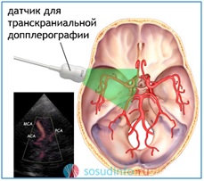 Ультразвукове дослідження судин шиї та головного мозку - дуплексне сканування судин -