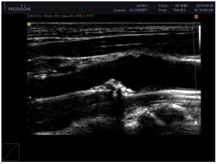 Examinarea cu ultrasunete a vaselor gatului și creierului - scanarea duplex a vaselor -