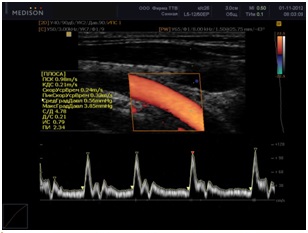 Ультразвукове дослідження судин шиї та головного мозку - дуплексне сканування судин -
