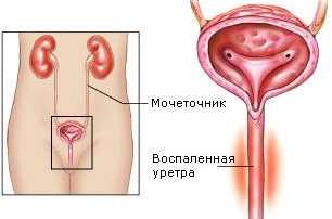 Simptome de uretră, tratament, motive, fotografie