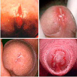 Simptome de uretră, tratament, motive, fotografie