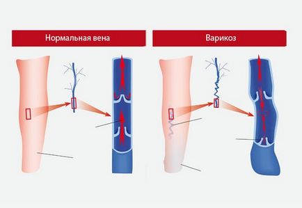 Urina pentru tratamentul venelor varicoase ale extremităților inferioare