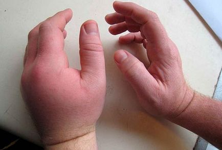 Забій кисті руки лікування, симптоми і перша допомога
