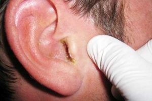 Urechea provoacă dermatită, tratarea fotografiilor