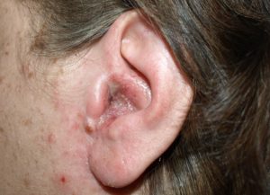 Fül dermatitis okoz tüneteket, kezelést Photo