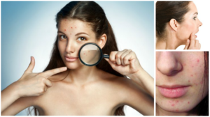 Îngrijire pentru piele problematică, gingii, acnee și sfatul unui cosmetolog